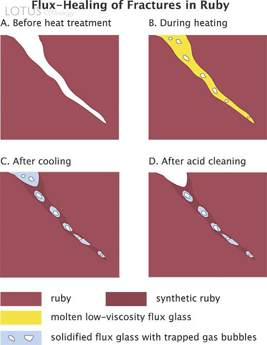 The mechanism of flux healing of a fracture in corundum. A. Open fracture/fissure, unhealed. B. During heat treatment, flux enters the fracture and dissolves the walls of the crack. C. During cooling, dissolved corundum recrystallizes in the crack, thus healing it closed. The newly crystallized ruby is essentially a synthetic ruby grown in the crack alone. It contains small pockets of now-solidified flux glass, along with some trapped gas pockets. For purposes of this diagram, the surrounding natural ruby and the synthetic ruby in the crack are shown in two different colors. In reality, no distinction can be seen between the surrounding ruby and the newly grown synthetic ruby. D. Any flux glass present on the surface can be dissolved away with acid. The synthetic ruby in the crack is unaffected by the acid, as is the ruby as a whole. (Illustration: R.W. Hughes; modified from H&auml;nni, 2001, SSEF). Lotus Gemology.