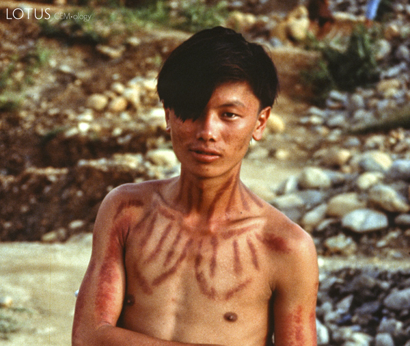 Bug spray Malaria is a major concern for anyone living or traveling in the jade-mines area. In this land of animism, the preferred local solution is embossing the skin by pinching it with a coin. The Maw-sisa miner at left is prepared for any kind of flying pest, as was Richard Hughes after he had the treatment applied. The efficacy of this bug protection was made crystal clear in Mogaung, where Hughes and Galibert slept side-by-side in the same bed. Come morning, Galibert's body was covered with bedbug bites, while Hughes was untouched.
